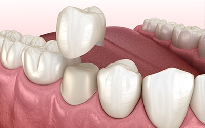 Capsula Dentale - Sostituzione di un singolo dente mancante con una capsula dentale presso la Clinica Dentale Ghiatto.