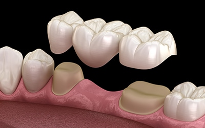 Ponte Dentale - Sostituzione di uno o più denti mancanti con un ponte dentale presso la Clinica Dentale Ghiatto.